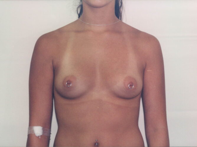 Breast Augmentation Patient 08 - Before - 1