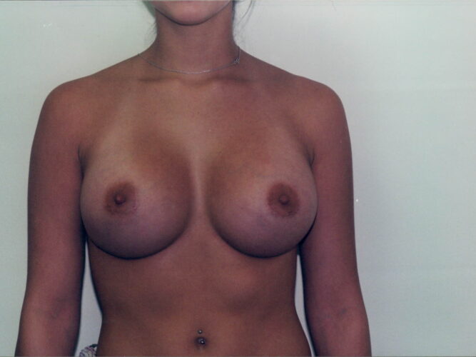 Breast Augmentation Patient 08 - After - 1