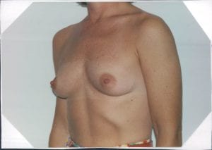 Breast Augmentation Patient 06 - Before - 2 Thumbnail