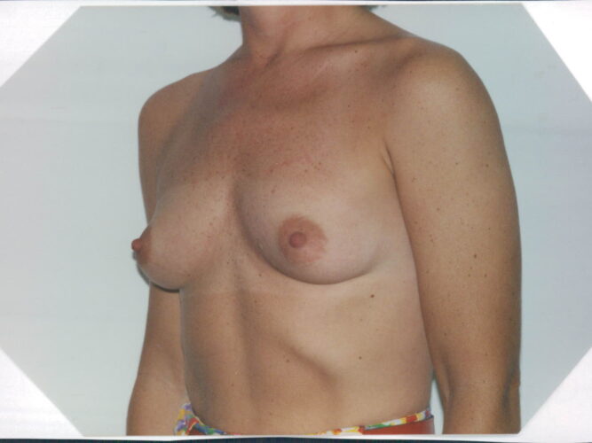 Breast Augmentation Patient 06 - Before - 2