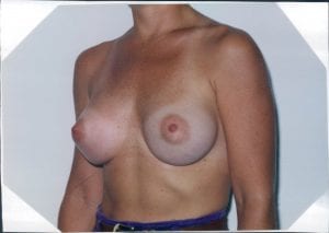 Breast Augmentation Patient 06 - After - 2 Thumbnail