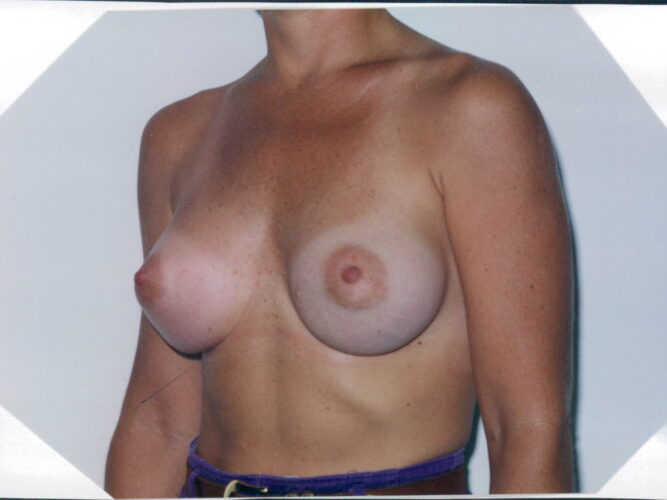 Breast Augmentation Patient 06 - After - 2