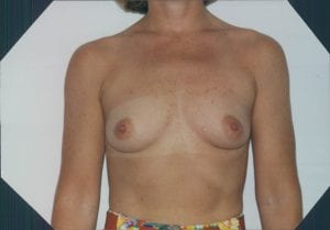 Breast Augmentation Patient 06 - Before - 1 Thumbnail
