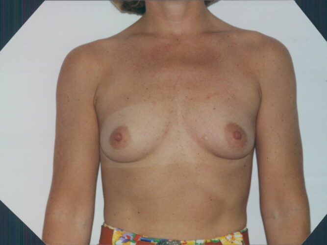 Breast Augmentation Patient 06 - Before - 1