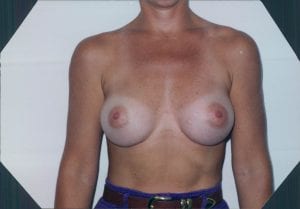 Breast Augmentation Patient 06 - After - 1 Thumbnail