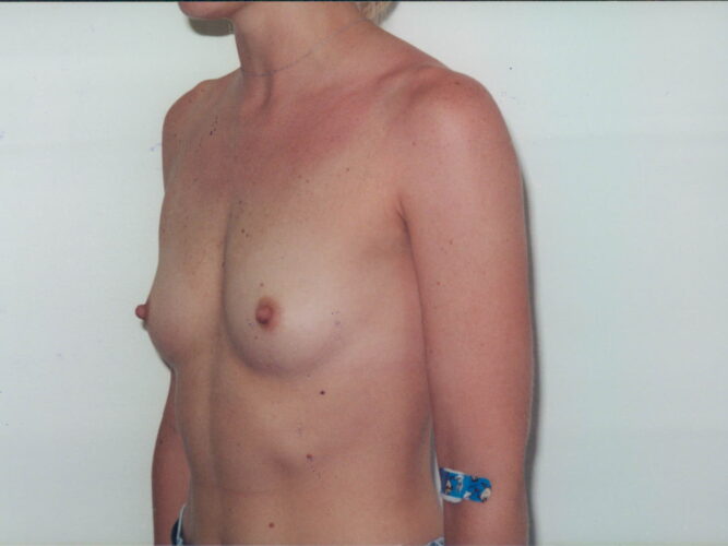 Breast Augmentation Patient 07 - Before - 1
