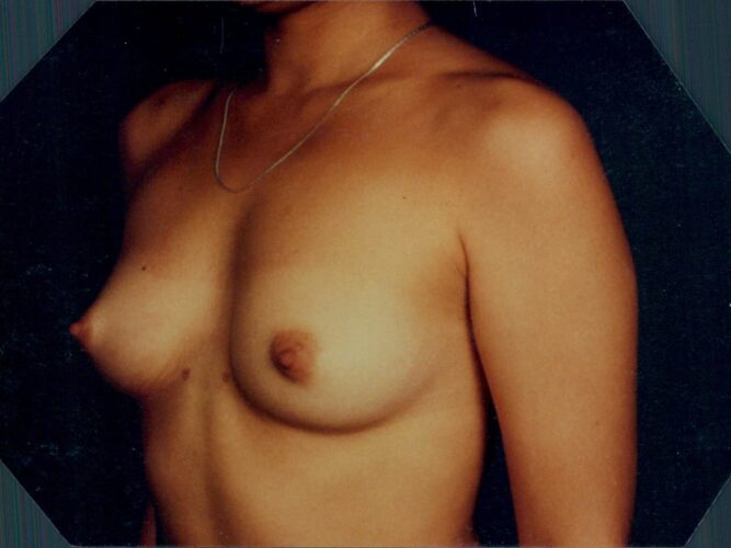 Breast Augmentation Patient 05 - Before - 1