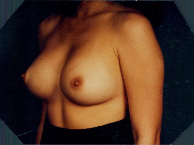Breast Augmentation Patient 05 - After - 1