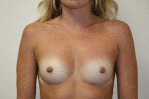 Breast Augmentation Patient 01 - Before - 1 Thumbnail