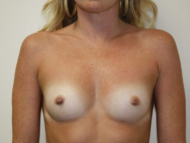 Breast Augmentation Patient 01 - Before - 1