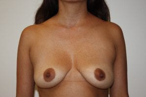 Breast Augmentation Patient 20 - Before - 1 Thumbnail