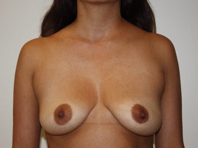 Breast Augmentation Patient 20 - Before - 1