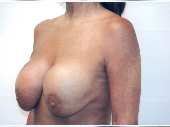 Breast Lift Patient 08 - Before - 1