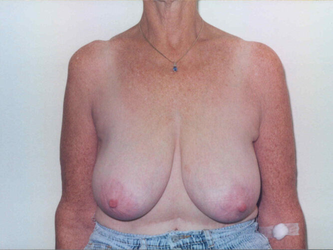Breast Lift Patient 25 - Before - 1