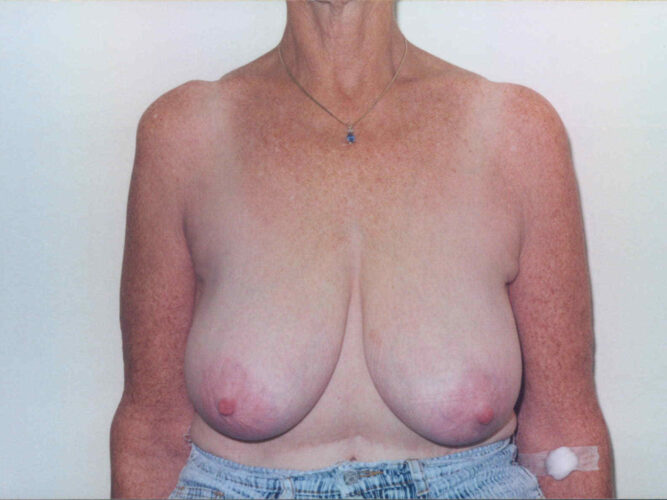 Breast Lift Patient 25 - Before - 1