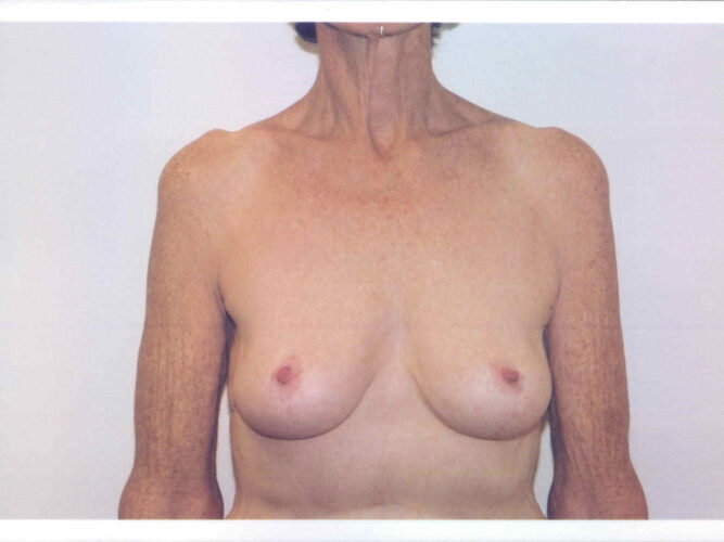 Breast Lift Patient 25 - After - 1