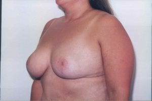 Breast Lift Patient 24 - After - 1 Thumbnail