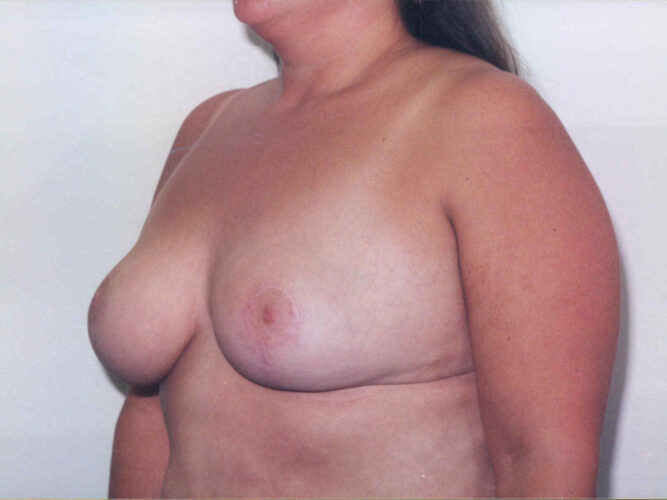 Breast Lift Patient 24 - After - 1