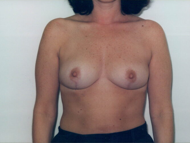 Breast Lift Patient 09 - After - 1