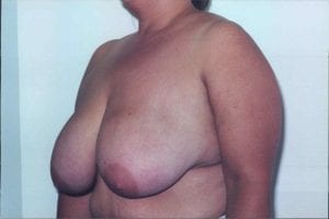 Breast Lift Patient 24 - Before - 1 Thumbnail