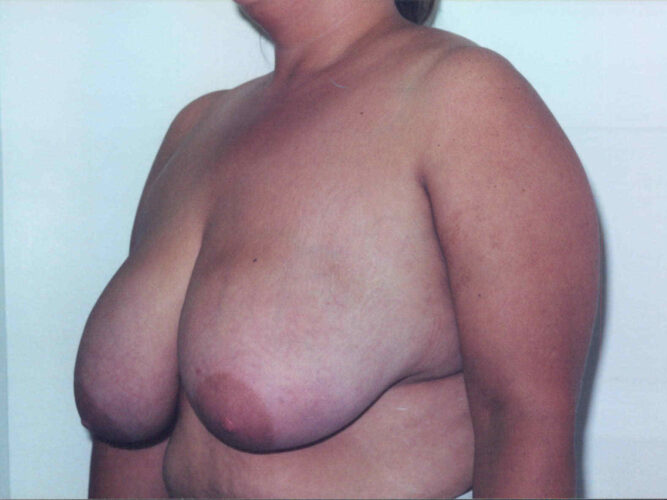 Breast Lift Patient 24 - Before - 1