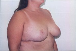 Breast Lift Patient 24 - After - 2 Thumbnail