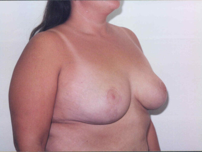 Breast Lift Patient 24 - After - 2