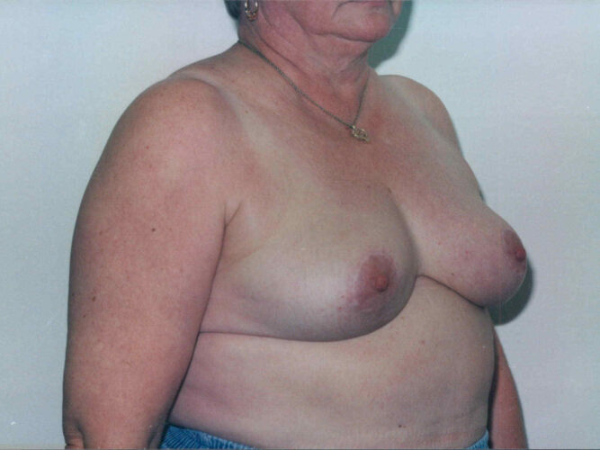 Breast Lift Patient 23 - After - 1