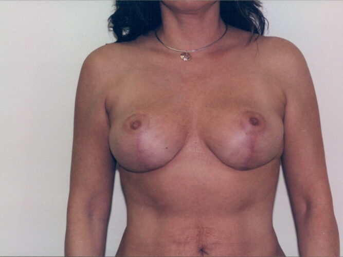 Breast Lift Patient 19 - After - 1