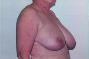 Breast Lift Patient 24 - Before - 2 Thumbnail