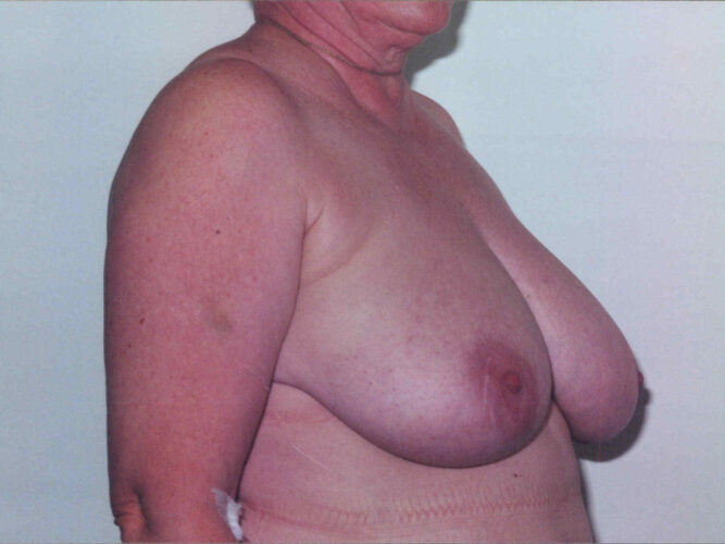 Breast Lift Patient 23 - Before - 1