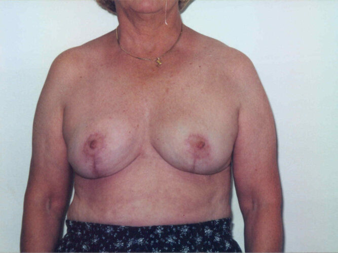 Breast Lift Patient 22 - After - 1