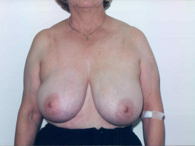 Breast Lift Patient 22 - Before - 1