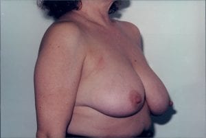 Breast Lift Patient 18 - Before - 2 Thumbnail