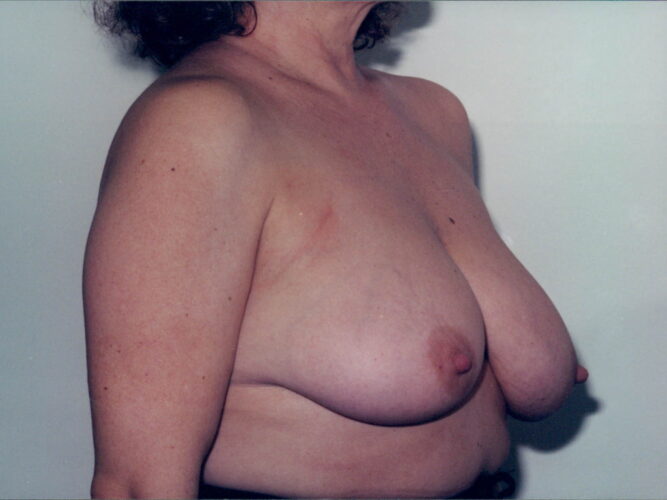 Breast Lift Patient 18 - Before - 2