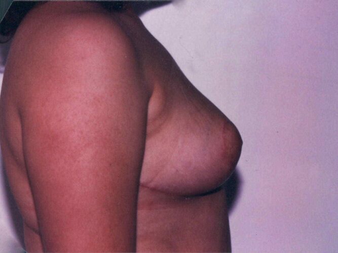 Breast Lift Patient 07 - After - 1