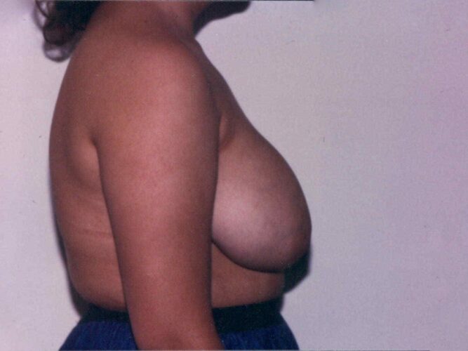 Breast Lift Patient 07 - Before - 1