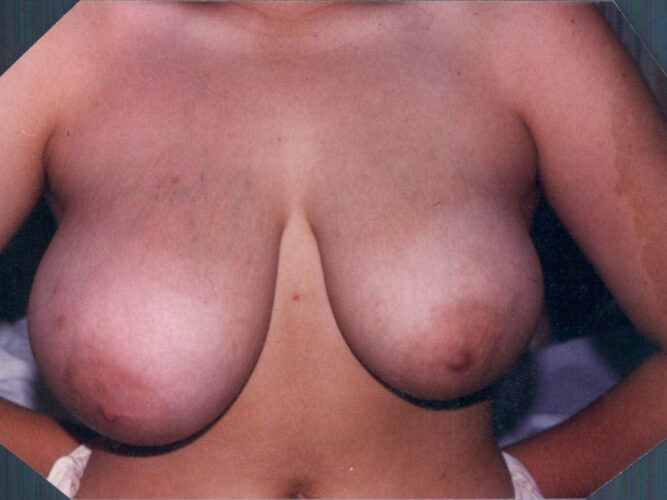 Breast Lift Patient 05 - Before - 1