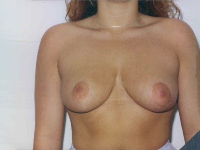Breast Lift Patient 05 - After - 1