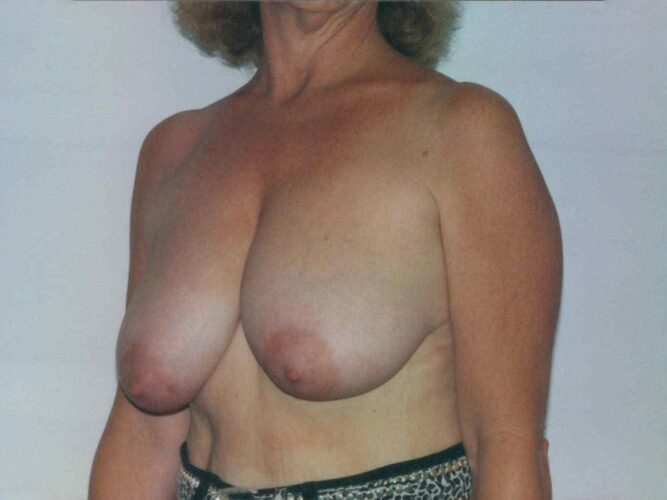 Breast Lift Patient 04 - Before - 1
