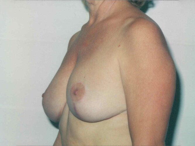 Breast Lift Patient 04 - After - 1
