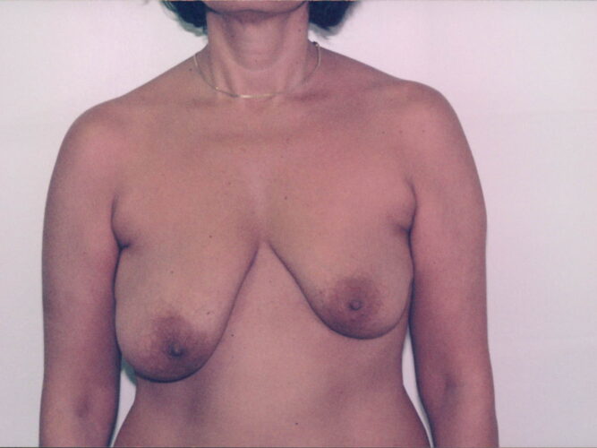 Breast Lift Patient 15 - Before - 1