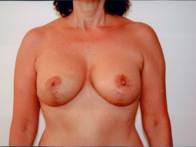 Breast Lift Patient 15 - After - 1