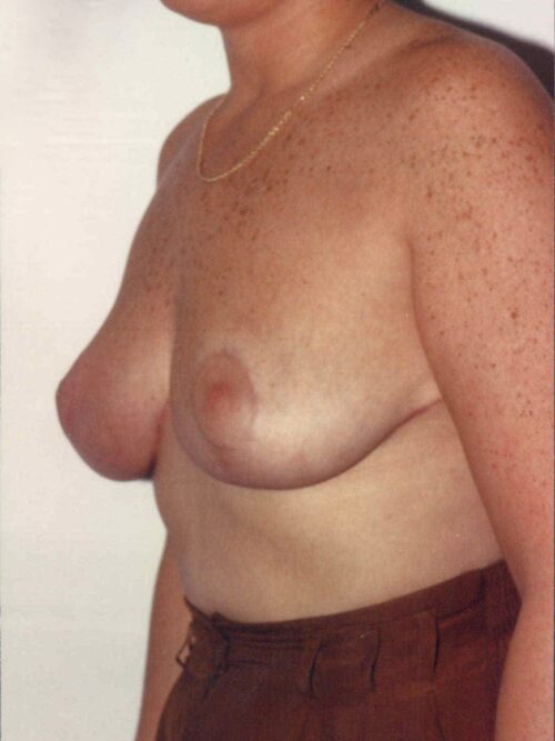Breast Lift Patient 01 - After - 1