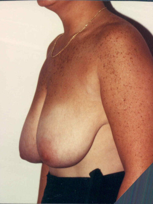 Breast Lift Patient 01 - Before - 1