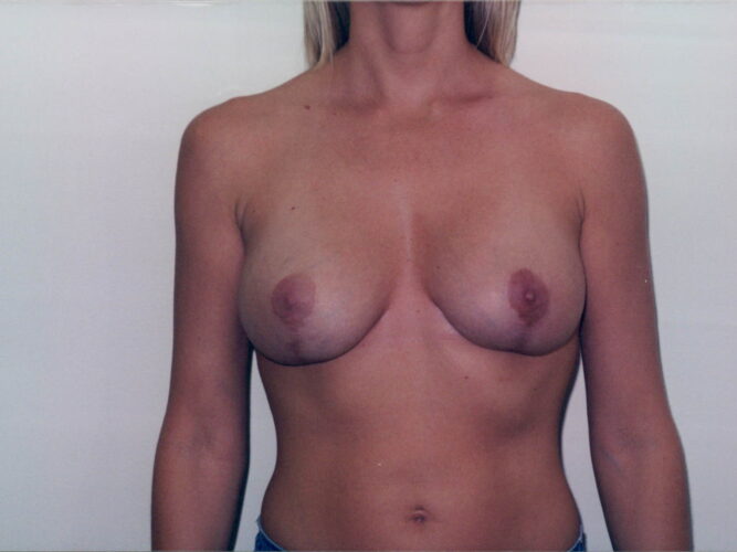 Breast Lift Patient 13 - After - 1