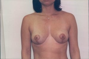 Breast Lift Patient 12 - After - 1 Thumbnail