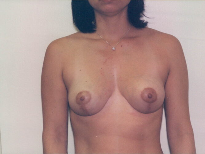 Breast Lift Patient 12 - After - 1