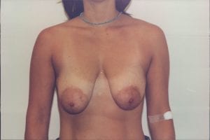 Breast Lift Patient 12 - Before - 1 Thumbnail