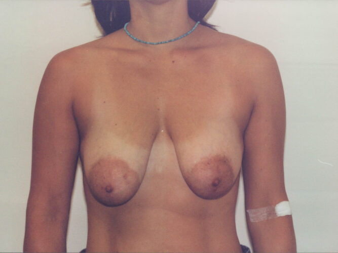 Breast Lift Patient 12 - Before - 1